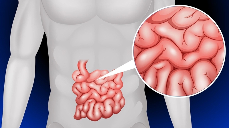 Viêm túi thừa Meckel là gì? Biến chứng hay gặp0