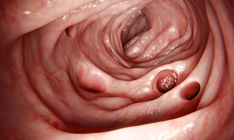 Viêm túi thừa Meckel là gì? Biến chứng hay gặp2