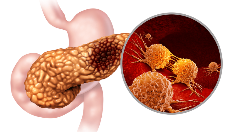 Viêm tụy cấp Balthazar E là gì? Chấm điểm Balthazar như thế nào? 2
