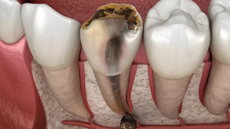 Viêm tủy răng là tình trạng viêm nhiễm ở phần tủy răng, nơi chứa dây thần kinh, mạch máu và mô liên kết