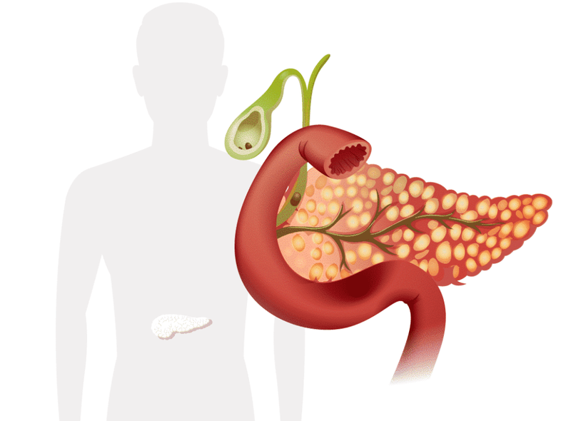 Viêm tụy sỏi mật là gì?