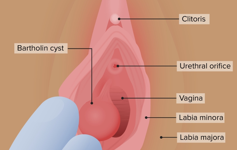 Viêm tuyến Bartholin 1
