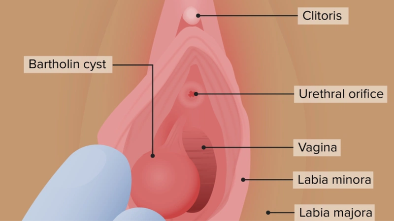Viêm tuyến bartholin bị vỡ nguy hiểm như thế nào? Phương pháp điều trị 1