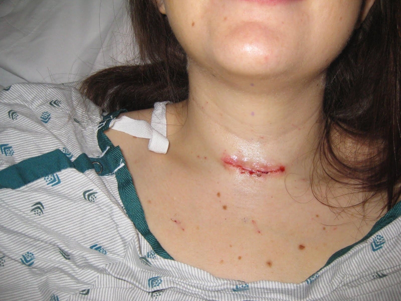 Viêm tuyến giáp sinh mủ: Tìm hiểu nguyên nhân và cách điều trị 3