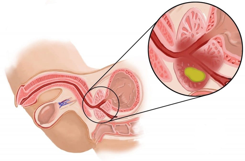Viêm tuyến tiền liệt ở người trẻ điều trị như thế nào? 1