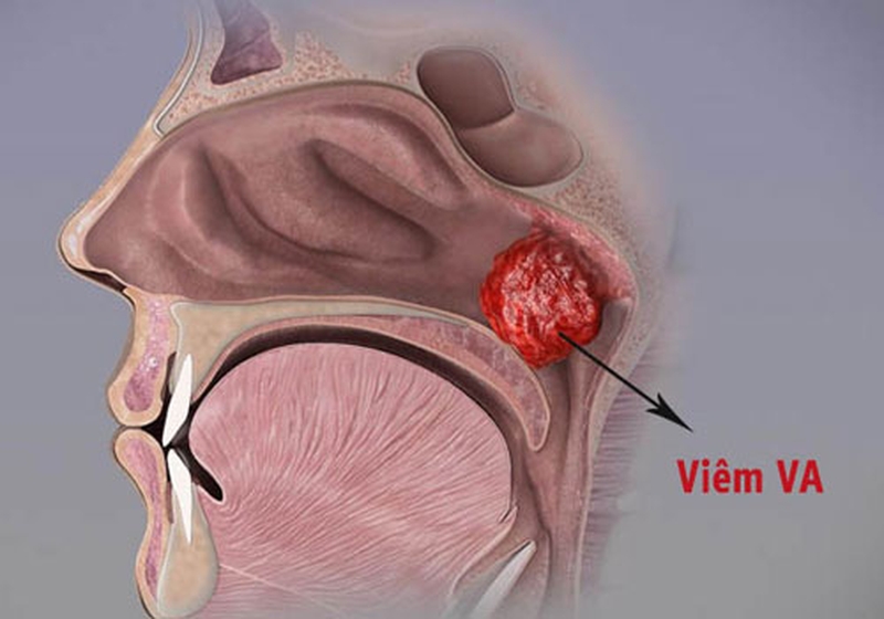 Viêm VA cấp độ 3 và phương pháp điều trị 2