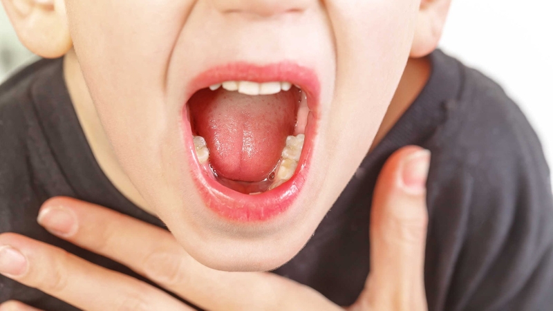 Hai giai đoạn viêm VA cấp tính và viêm VA mạn tính và cách điều trị 2