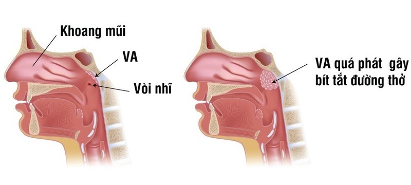 Viêm VA ở trẻ có lây không? Các loại viêm VA và biến chứng 1