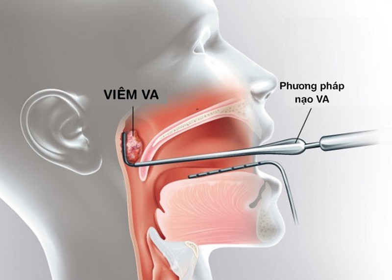 Viêm VA ở trẻ có lây không? Các loại viêm VA và biến chứng 3