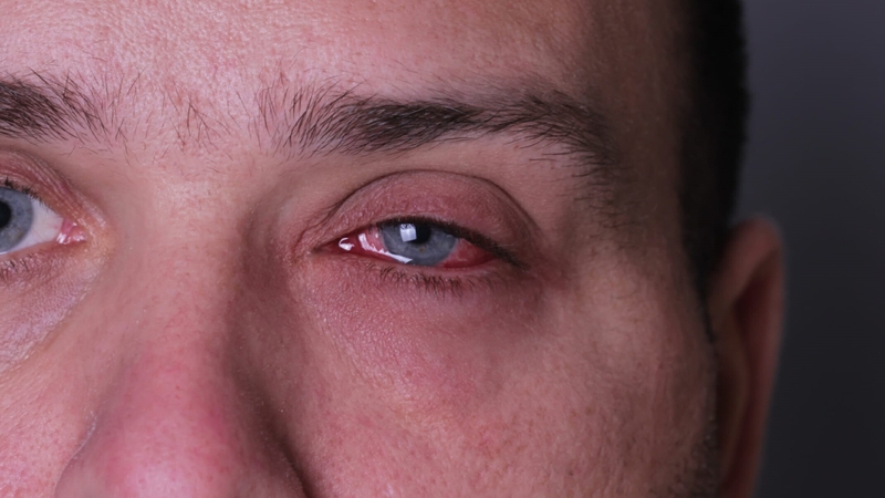 Viêm xoang do nấm là gì? Những vấn đề cần biết về viêm xoang do nấm 2