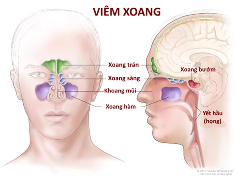 Viêm xoang hàm là gì và phải điều trị ra sao 2