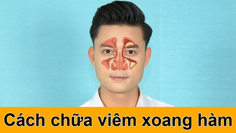 Viêm xoang hàm là gì và phải điều trị ra sao 3