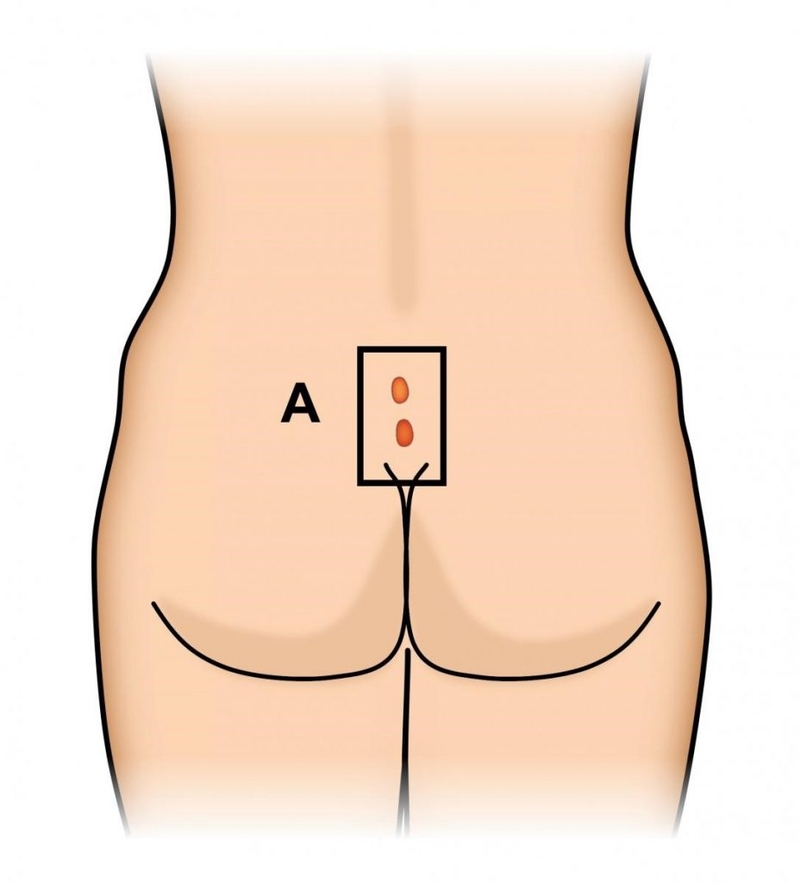 Viêm xoang lông vùng cùng cụt là gì?