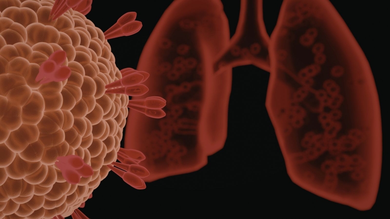 Viêm xoang mạn tính còn có thể ảnh hưởng sâu xuống đường hô hấp dưới, làm gia tăng rủi ro mắc bệnh ung thư phổi