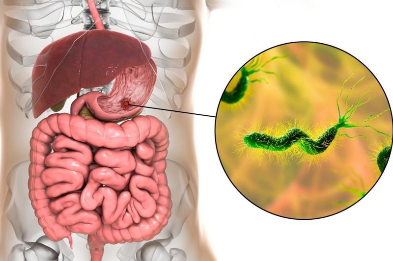 Viêm xung huyết hang vị dạ dày là gì? Những vấn đề cần biết về viêm xung huyết hang vị dạ dày 5