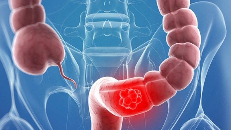 Viêm xung huyết trực tràng là gì? Nguyên nhân và dấu hiệu nhận biết 1