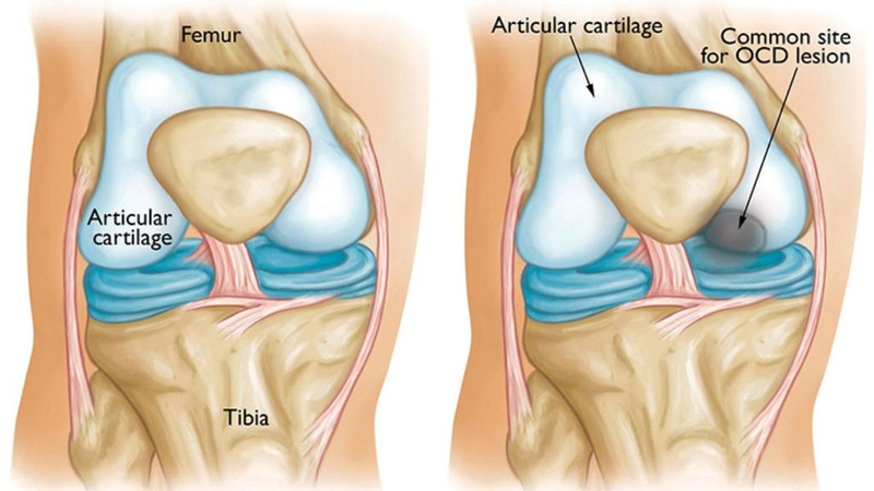 Viêm xương sụn bóc tách và những điều cần biết 2