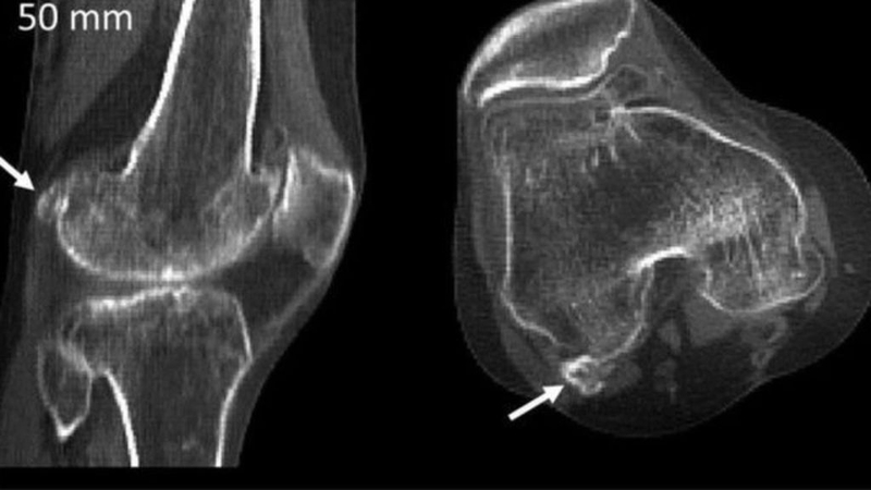 Viêm xương vừng và những điều cần biết về bệnh 1