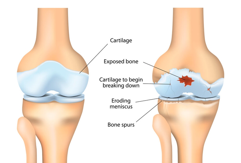 Viêm khớp mạn tính là gì? Những vấn đề cần biết về bệnh viêm khớp mạn tính1