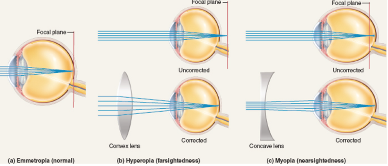 Viễn thị đeo kính gì? Cách chọn kính cho người viễn thị 1