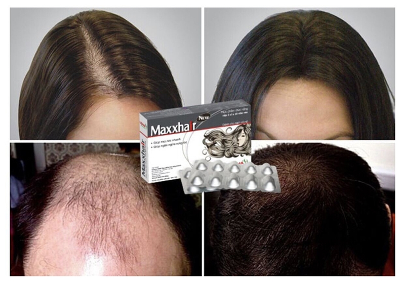 Viên uống mọc tóc Maxxhair giá bao nhiêu 2
