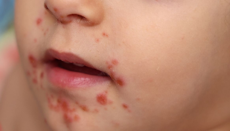 Virus Coxsackie A16 là gì? Gây bệnh gì và cách phòng ngừa ra sao 2