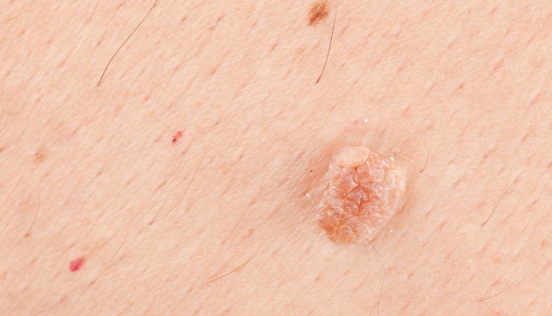 Virus HPV gây bệnh gì ở nam giới? Cách phòng ngừa HPV hiệu quả 3