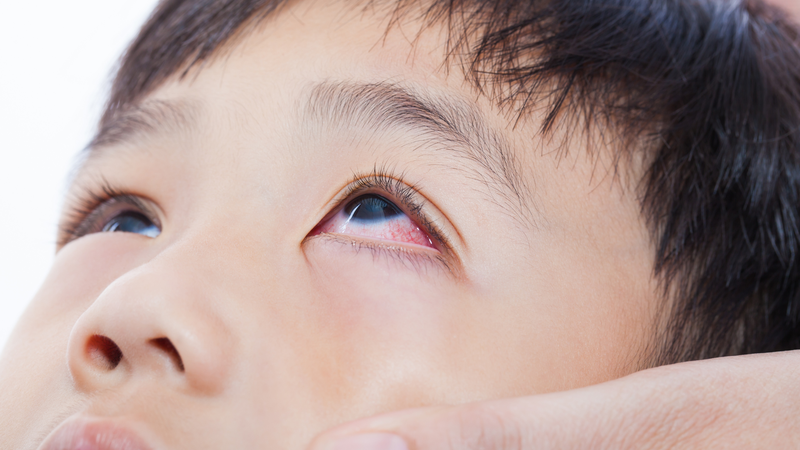 Virus Adeno đau mắt đỏ là cách gọi thông thường của bệnh viêm kết mạc do Adenovirus