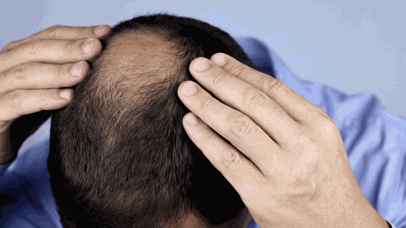 virus hói hiện tượng lạ kỳ khiến rụng tóc chỉ trong vài ngày 1