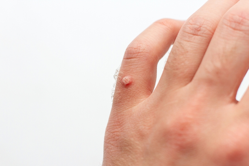 Virus HPV ở nam giới: Tầm soát và phòng ngừa 2