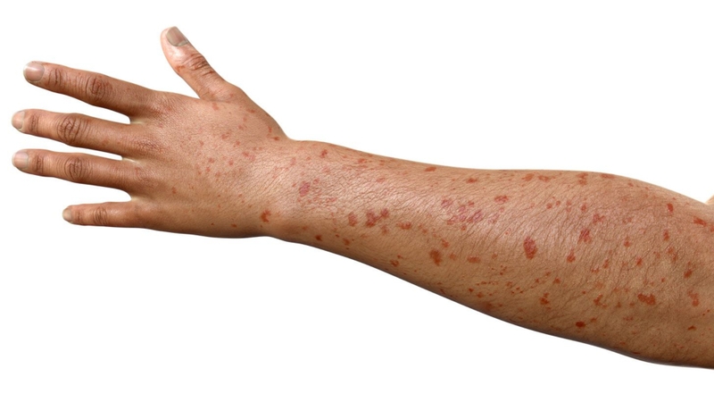 Sau vài ngày, có thể xuất hiện ban đỏ kèm theo các điểm xuất huyết nhỏ dưới da