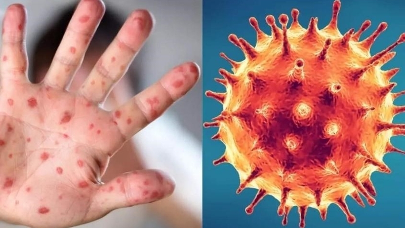 Virus đậu mùa là cái tên gây khiếp sợ trong lịch sử nhân loại