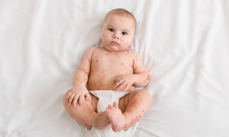 Virus Paramyxovirus: Nguyên nhân gây nhiều bệnh lý nguy hiểm 4