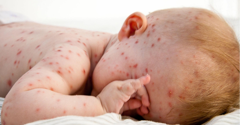 Virus thủy đậu sống trong bao lâu? Cách chữa trị và phòng ngừa 1