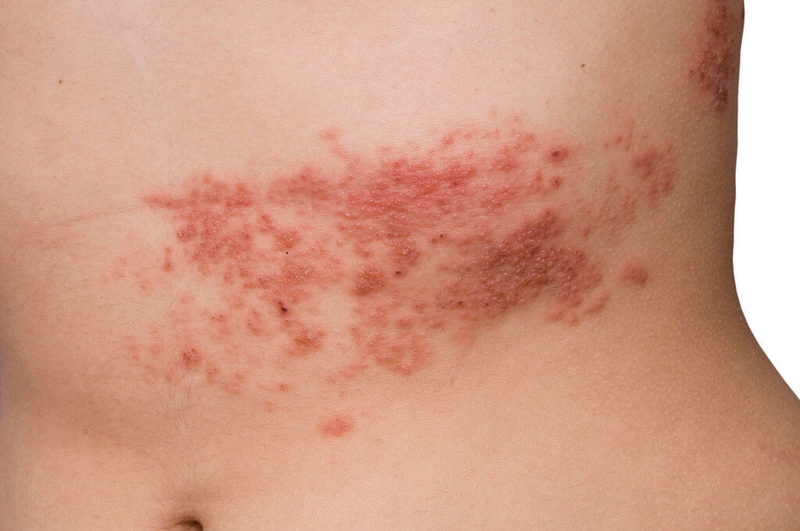Virus Varicella Zoster là gì? Virus Varicella Zoster gây ra những bệnh lý nào? 3