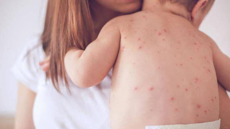 Virus zika lây qua đường nào? Những điều cần lưu ý về bệnh mà bạn cần biết 3