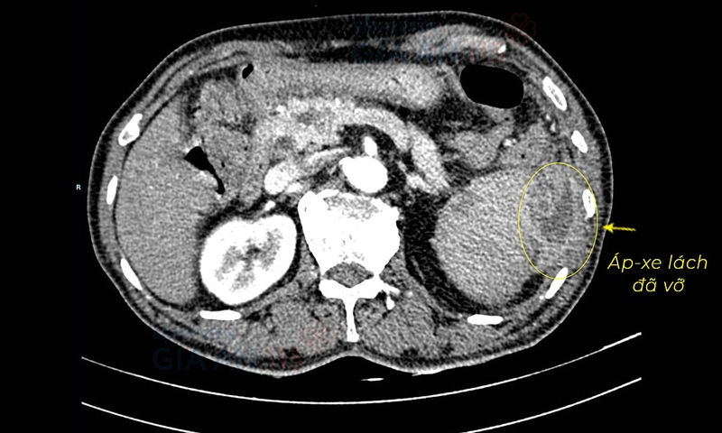 Vỡ lá lách có nguy hiểm không? Cách nhận biết và điều trị? 2