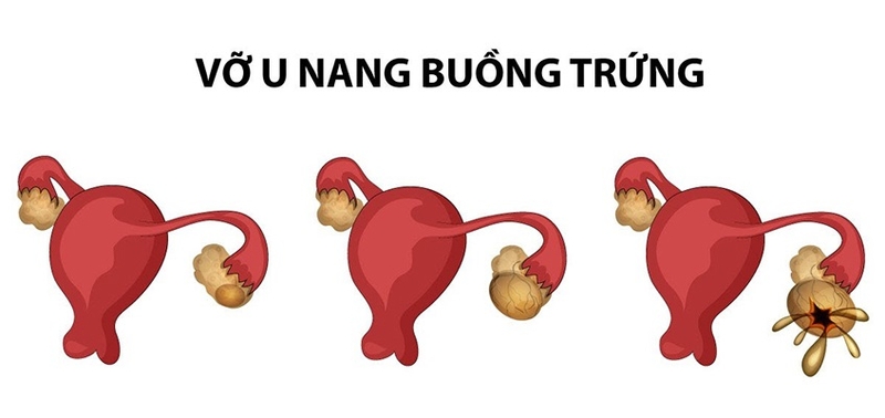 Biến chứng u nang buồng trứng bị vỡ có nguy hiểm không? 1