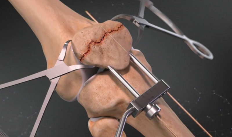 Vỡ xương bánh chè đầu gối có đi lại được không? 2