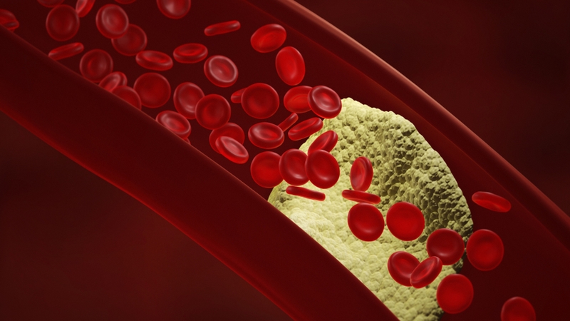 Vôi hóa mạch máu có nguy hiểm không 1