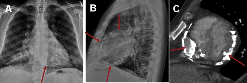 Vôi hóa mạch máu có nguy hiểm không? 2