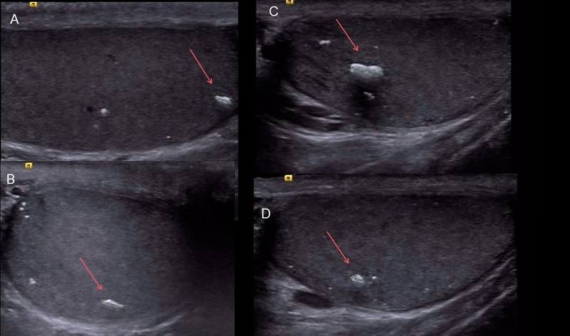 Vôi hóa tinh hoàn là gì? Nguyên nhân, triệu chứng, cách điều trị 1