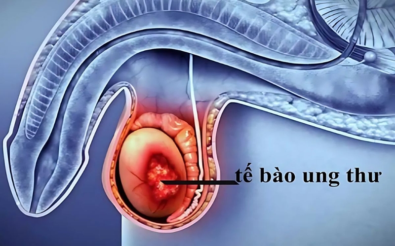 Vôi hóa tinh hoàn là gì? Nguyên nhân, triệu chứng, cách điều trị 2