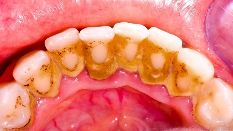 Vôi răng bị vỡ: Nguyên nhân, giải pháp và cách phòng ngừa 1