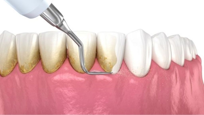 Vôi răng bị vỡ: Nguyên nhân, giải pháp và cách phòng ngừa 2