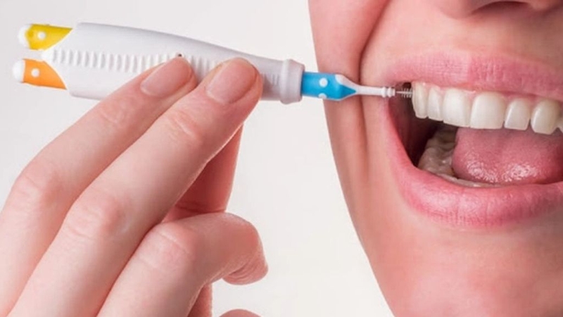 Vôi răng bị vỡ: Nguyên nhân, giải pháp và cách phòng ngừa 3