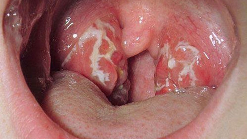 Vòm họng nổi hạt: Nguyên nhân và lưu ý 2