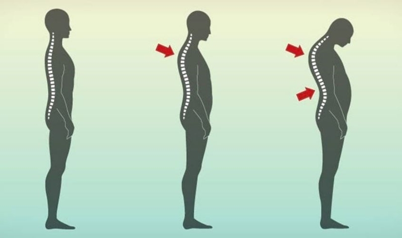 Võng lưng là một dạng vẹo cột sống phổ biến