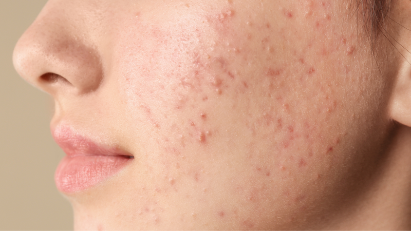 Vòng tránh thai Mirena giá bao nhiêu? Có tác dụng phụ gì không? 4