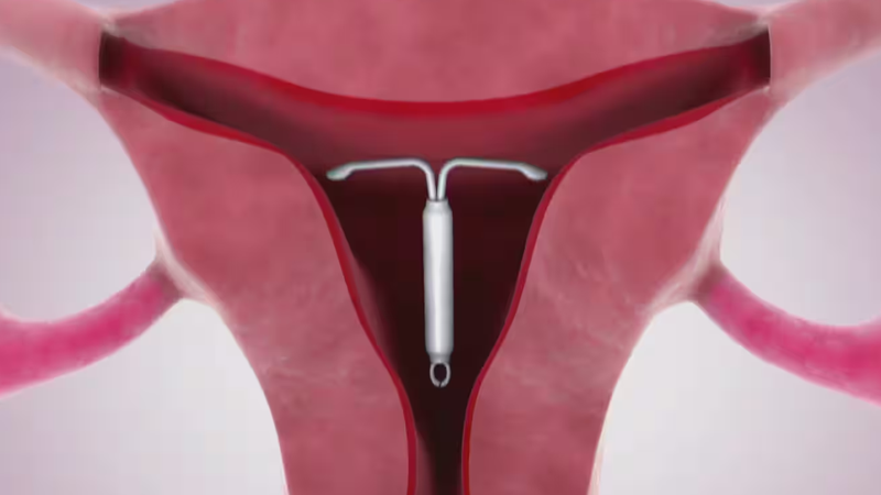 Vòng tránh thai nội tiết Mirena là gì và hiệu quả của nó như thế nào? 2